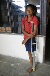 Mały Timorczyk z amputowaną nogą. Zdjęcie ze strony organizacji Assert.